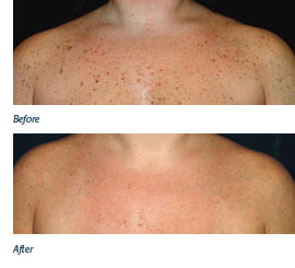 Chris's Skin Tags - Before & After